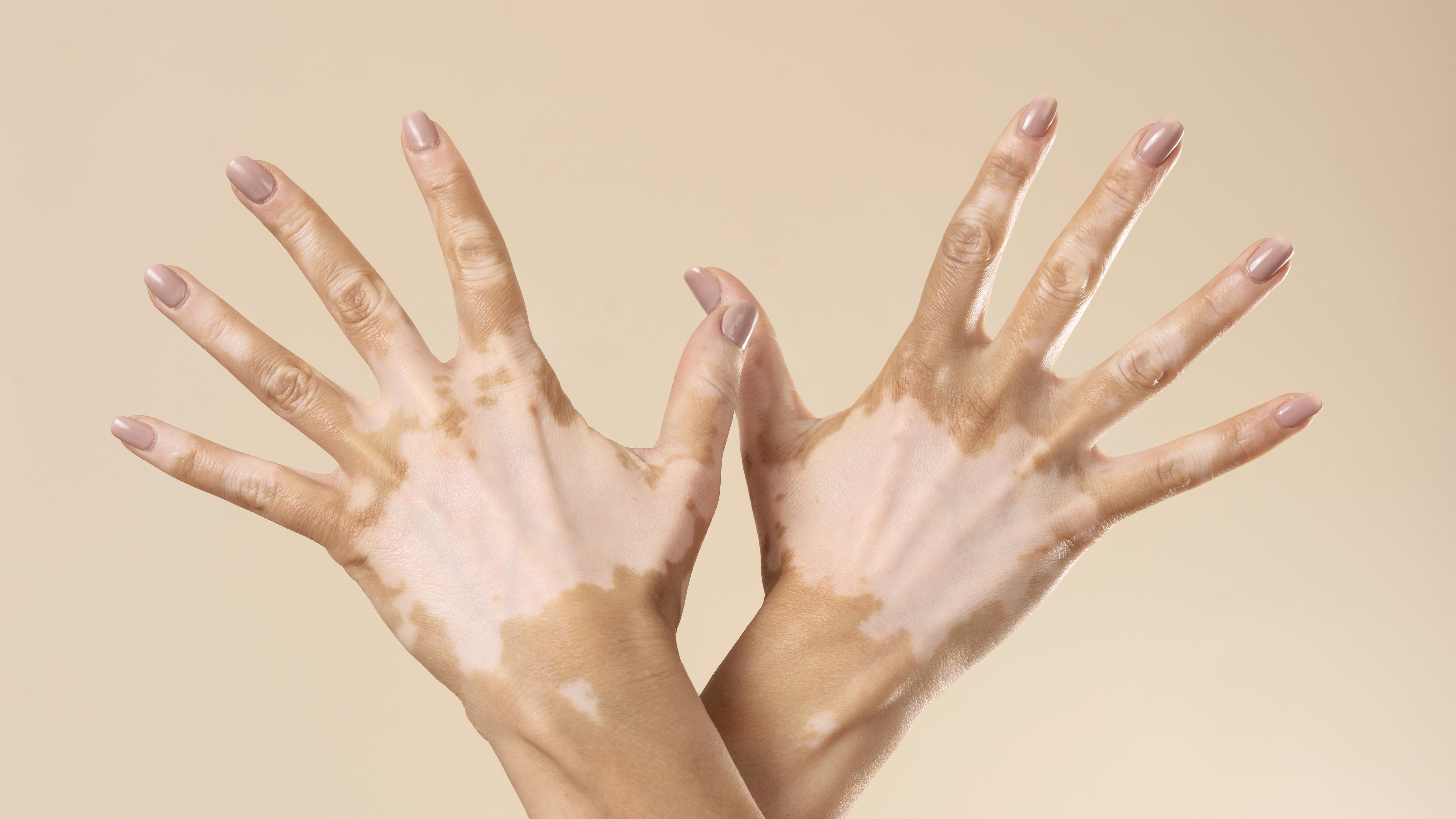 Foto de duas mãos com vitiligo